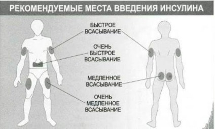 Az inzulin injekciók szabályai (szabályok) Az inzulin injekciók szabályai