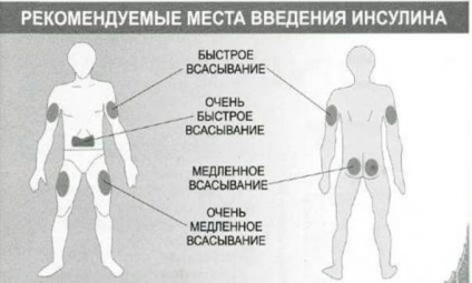 Reguli de injecții cu insulină