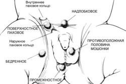 Criptorhidismul din dreapta provoacă patologia