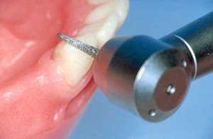 Disecția dinților pentru coroane - plastic solid, ștanțat