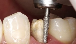 Disecția dinților pentru coroane - plastic solid, ștanțat