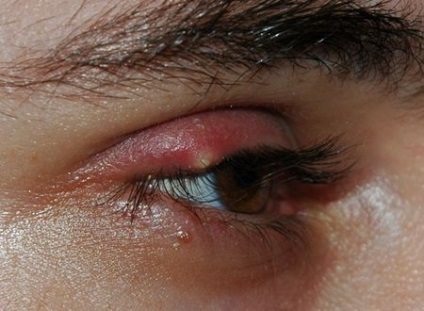 Cauze și tratamentul temperaturii și durerii în ochi