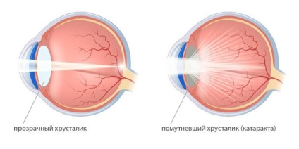 Cauzele simptomelor de cataractă, metodele de tratament, prevenirea
