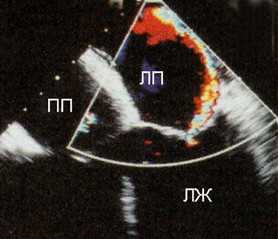 Afecțiuni cardiace dobândite