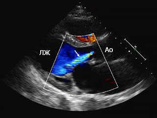 Afecțiuni cardiace dobândite