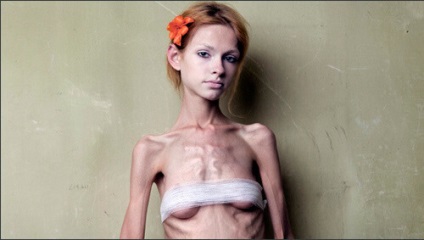 Mental anorexia simptome, cauze, tratament