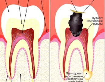 Pulpita dintelui ce este si cum se trateaza, simptome, on-line sanatos