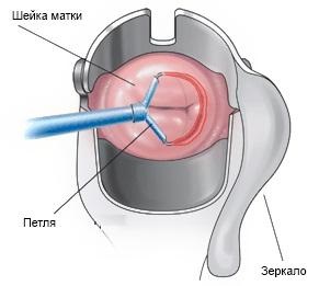 Tratamentul radiosurgical al patologiei cervicale, metode hardware de tratament și diagnostic, mc -