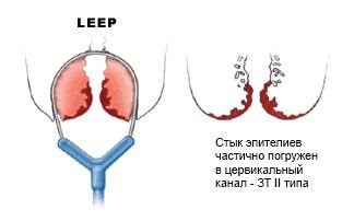 Tratamentul radiosurgical al patologiei cervicale, metode hardware de tratament și diagnostic, mc -