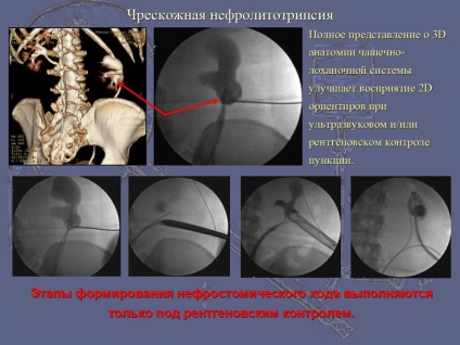 Extinderea rinichilor pe care se află