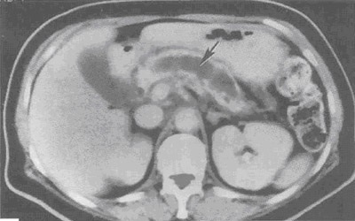 Diagnosticarea secțiunilor de laborator și instrumentale a pancreatitei cronice dependente de biliară