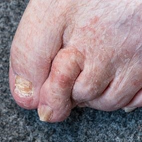 A rheumatoid arthritis stádiumának röntgen-jelei és jellemzői