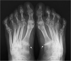 Semnele radiografice ale stadiului și caracteristicilor artritei reumatoide