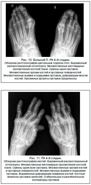 Etapele radiografice ale artritei reumatoide