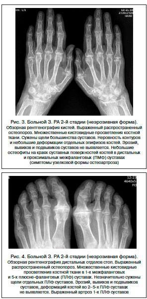 Etapele radiografice ale artritei reumatoide