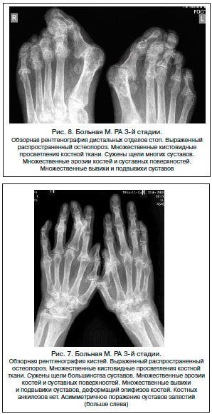 Etapele radiografice ale artritei reumatoide