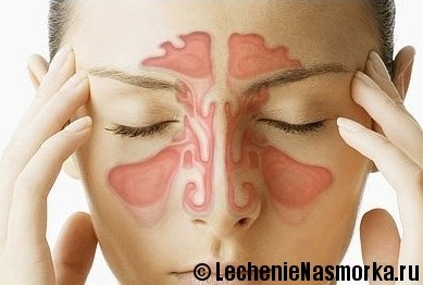 Rhinitis tünetek és kezelés felnőtteknél