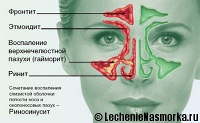 Rhinitis tünetek és kezelés felnőtteknél