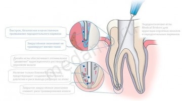 Seringile și acele sunt endodontice, cel mai bun preț!