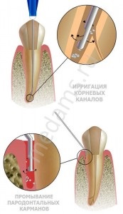 Seringile și acele sunt endodontice, cel mai bun preț!