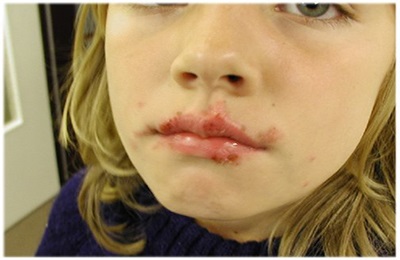 Simptomele și semnele de herpes pe buze cum se determină forma labială