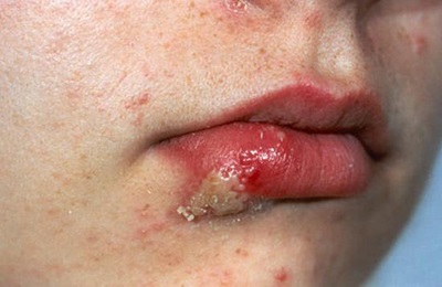 Simptomele și semnele de herpes pe buze cum se determină forma labială