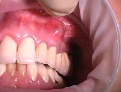 Fistula asupra tratamentului cu gingia, cauze și simptome