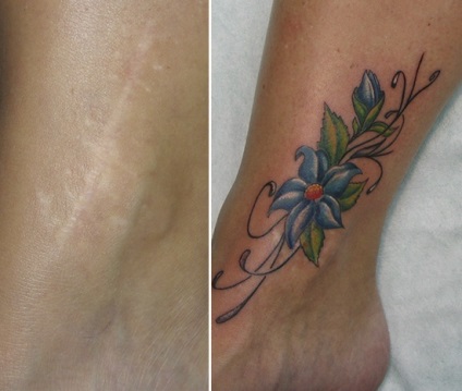 Tattoo pe cicatrice (cum să ascundeți cicatricile cu ajutorul unui tatuaj și dacă merită să faceți acest lucru)