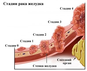 Îndepărtarea stomacului în cancer, tratamentul cancerului și prevenirea acestuia