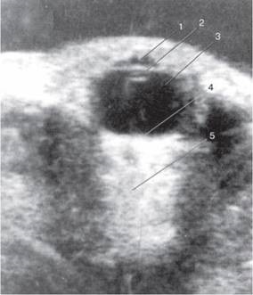 Diagnosticul ultrasunetelor oftalmologilor a apreciat rolul și semnificația ultrasunetelor, ambele