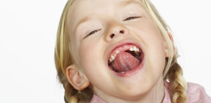 Unghiul buzei superioare a copilului, ce trebuie făcut dacă sa rupt, modul în care se efectuează operația, fotografii și video