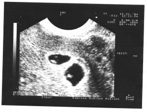Uzi 5 săptămâni de sarcină - studiu de numire, concluzie, fotografie, video