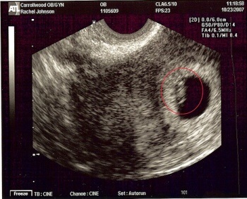 Uzi a terhesség 5. hetében fotó, norma, analízis-uzi