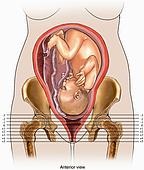 Pelvisul îngust, pelvisul anatomic, îngust clinic, travaliul cu un pelvis îngust