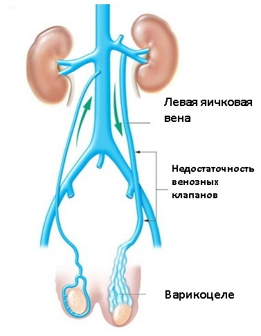 Varicocele cauze, simptome, tratament, consecințe