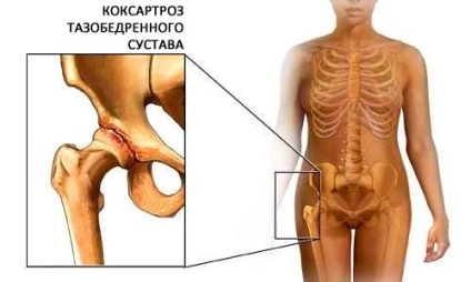 Gyakorló kerékpár térd- és csípőízületek arthrosisával