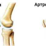 Biciclete de exerciții cu artroză articulației genunchiului