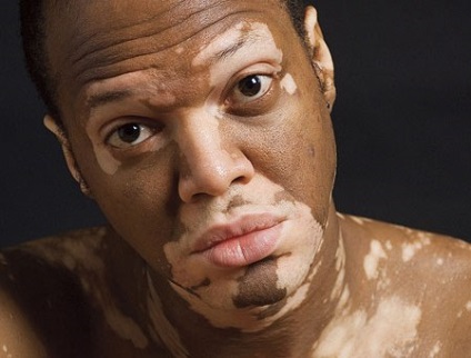 Cauzele vitiligo