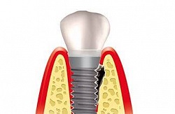 Maxillofacial terület gyulladásos betegségei