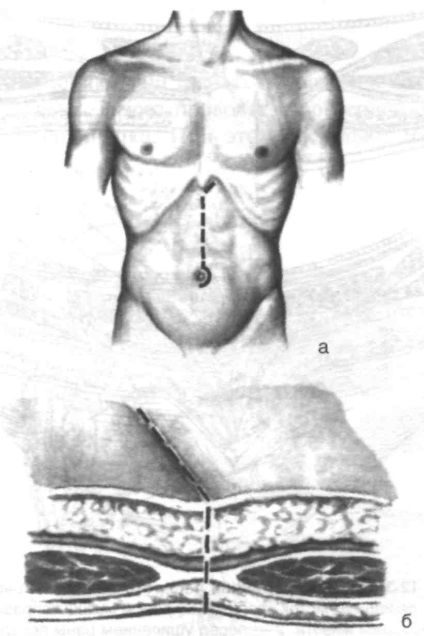 Accesul chirurgical la organele cavității abdominale