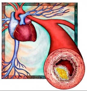 Plachete de colesterol în vase, artera carotidă și pe îndepărtarea feței fără intervenție chirurgicală, tratament, purificare