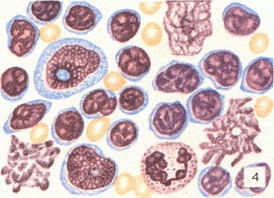 Tratamentul simptomatic al leucemiei limfocitare cronice