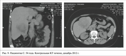 Sănătatea Kazahstanului - chemoembolizarea transarterială a leziunilor hepatice ale ficatului