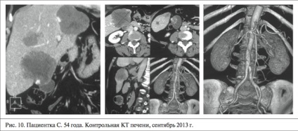 Sănătatea Kazahstanului - chemoembolizarea transarterială a leziunilor hepatice ale ficatului