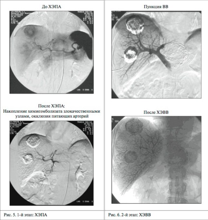 Sănătatea Kazahstanului - chemoembolizarea transarterială a leziunilor hepatice ale ficatului