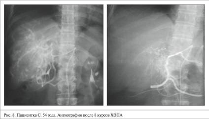 Sănătatea Kazahstanului - chemoembolizarea transarterială a leziunilor hepatice ale ficatului