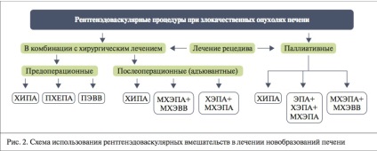 Sănătatea Kazahstanului - chemoembolizarea transarterială a leziunilor hepatice ale ficatului