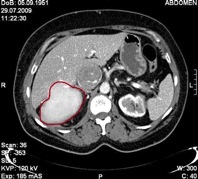 Adrenocortical cancer