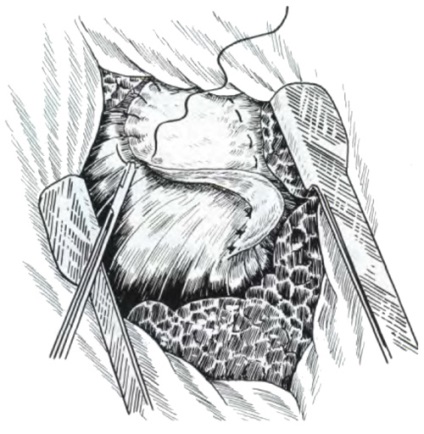 Allsurgery - diafragma hernia adecvata