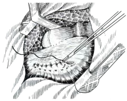 Allsurgery - diafragma hernia adecvata